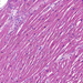 Atrophia brunea cordis-lipofuscin (and pericarditis)1