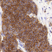 carcinoma ductale invasivum mammae (Her-2)