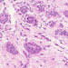 carcinoma ductale invasivum mammae fent ép ductus