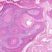 carcinoma planocellulare cutis 2