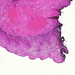 cervix in situ carcinoma viszonylag ép