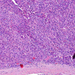 Carcinoma hepatocellulare0
