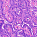 carcinoma papillare thyroideae2