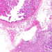 carcinoma transitiocellulare daganatos, ép, veseszövet