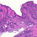 bronchus-metaplasia-dysplasia-carcinoma1