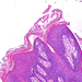 papilloma laryngis 2