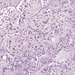 tuberculosis pulmonis ZN makrophagok hemosziderinnel